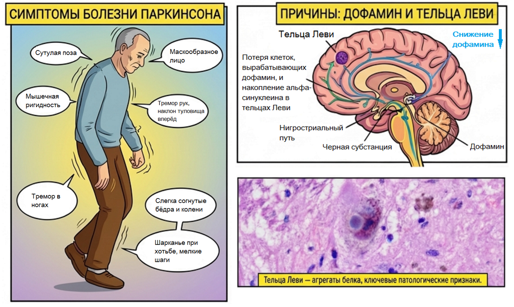 Двигательные симптомы болезни Паркинсона, дофаминовые пути и проекции в головном мозге, изображение телец Леви