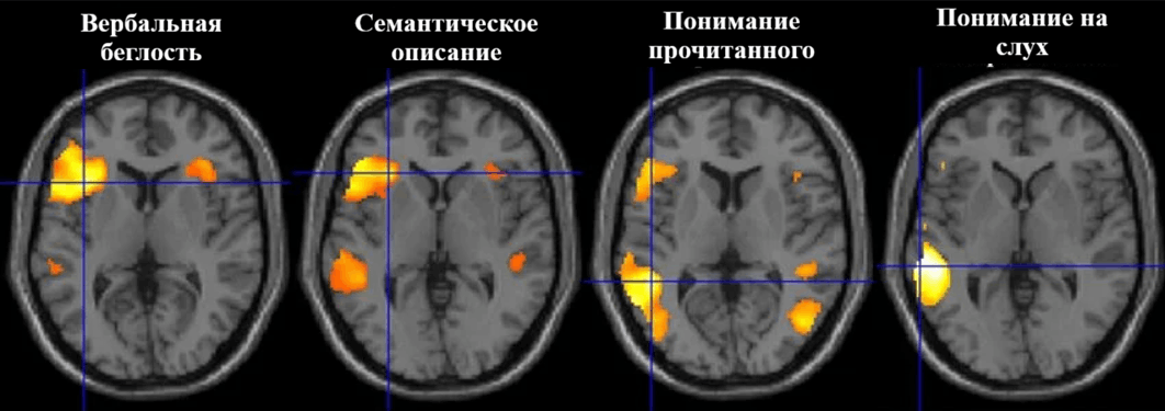 Анализ второго уровня для фМРТ с выполнением заданий у пациентов-правшей