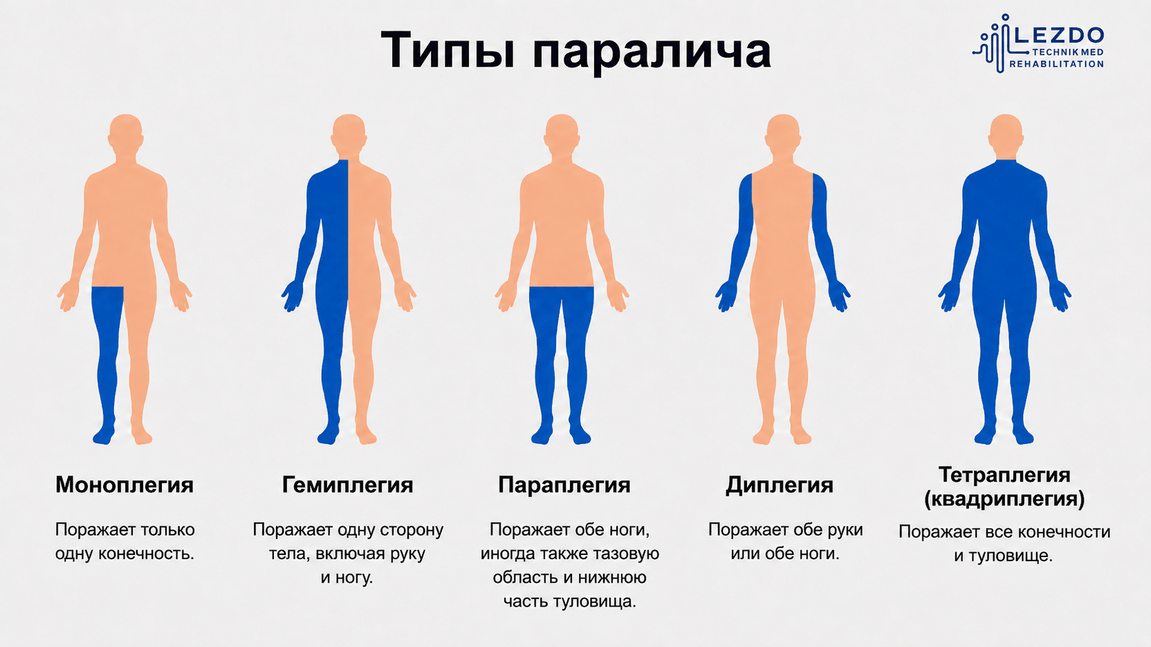 Типы паралича описывают не диагноз, а «карту» нарушений движения