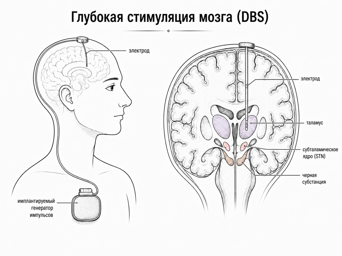 Схема устройства для глубокой стимуляции мозга