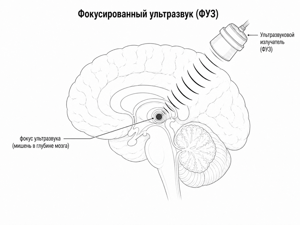 Схема применения фокусированного ультразвука (ФУЗ) на мозге