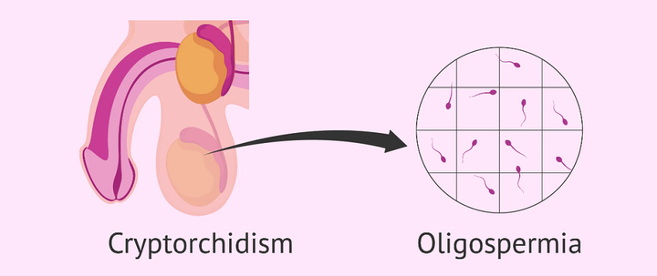 Крипторхизм (и речь сейчас не про крипту)