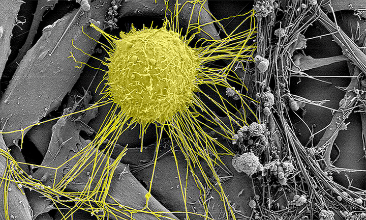 Путь клетки «из греков в варяги». Малигнизация: причины и следствия