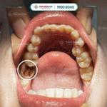 Điều trị tủy răng