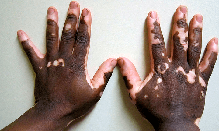 Загадочная генетика «загадочной болезни кожи» — витилиго