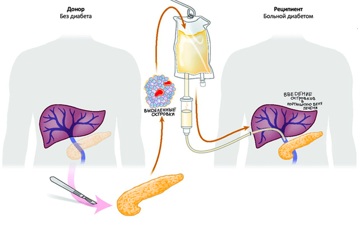 Трансплантация островков поджелудочной железы: как, кому и почему не всем?