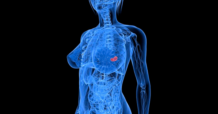 Роль питания в лечении рака груди