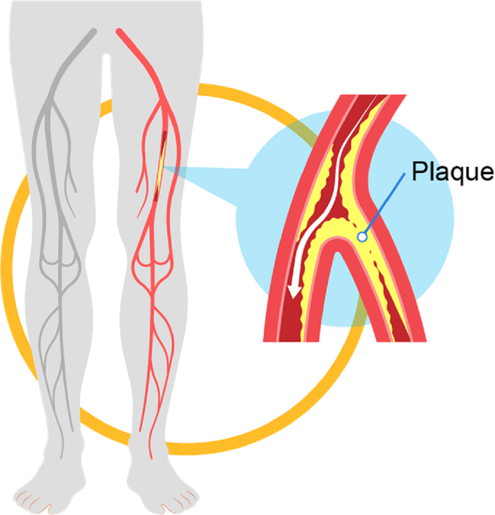Путь к спасению: клеточная и генная терапии в борьбе с заболеваниями периферических артерий
