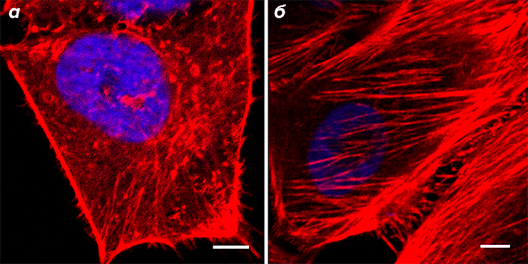 Актиновый цитоскелет клетки рака и клетки доброкачественной опухоли молочной железы