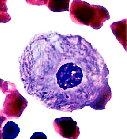 Клетка человека с болезнью Гоше