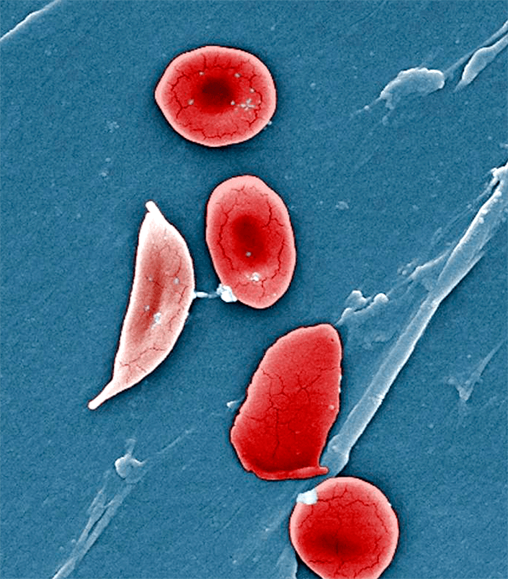 Эритроцит, имеющий характерную для больного серповидно-клеточной анемией форму