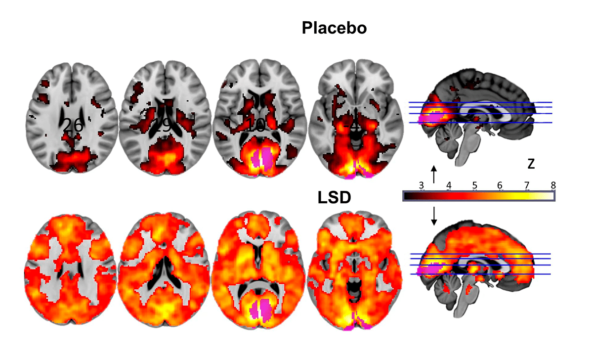 Функциональная магнитно-резонансная томография зон мозга